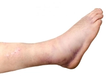 Topuk Şişmesi Belirtileri ve Tedavisi